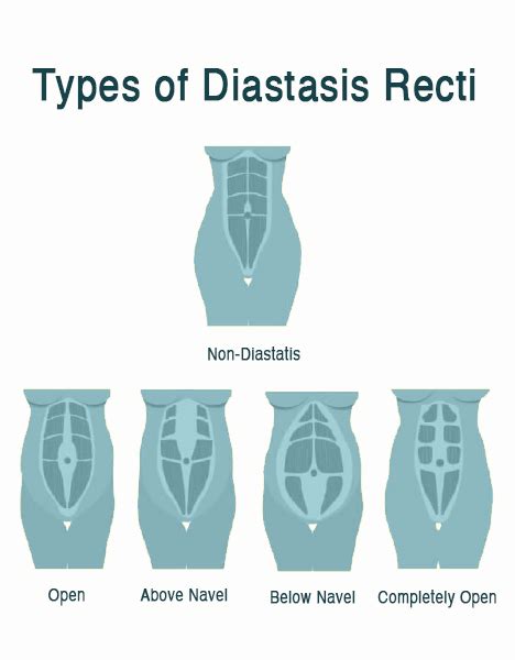 Diastasis Recti: Abdominal Separation FAQs - The Iskandar Complex ...