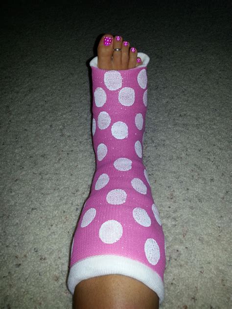 How to decorate your cast! Spray paint it pink then add white poka-a-dots!!!! SUPER CUTE ...