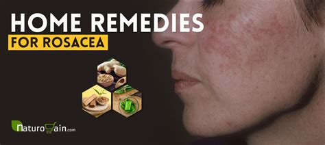 6 DIY Home Remedies for Rosacea - Natural Skin Care Tips