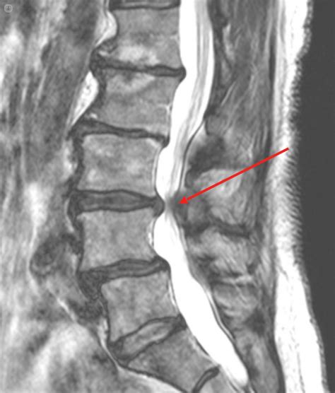 Could you have spinal stenosis? Make the diagnosis and treat it effectively - The UK Spine Centre