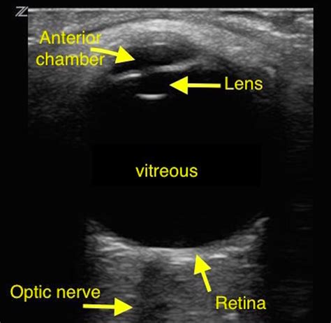 Case of the Month: Retinal Detachment – AOMC FOAMed