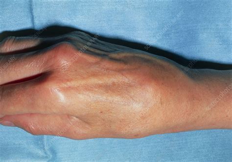 Swollen right hand due to osteoarthritis in wrist - Stock Image - M110/0332 - Science Photo Library