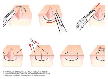 INTERRUPTED SUTURE – Katsan Tıbbi Cihazlar