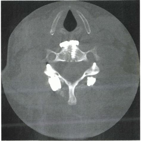 Vascular Complications in Cervical Spine Surgery | Musculoskeletal Key