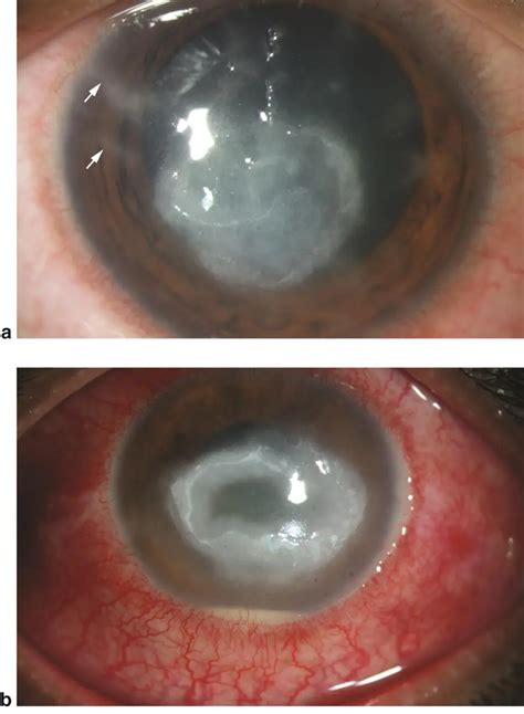 Clinical signs of Acanthamoeba keratitis - American Academy of Ophthalmology