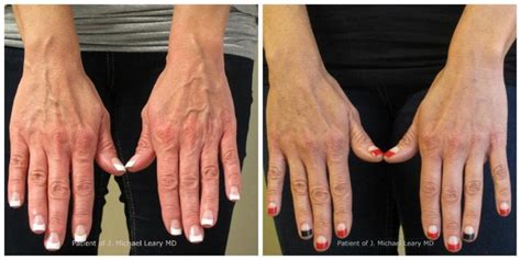 Hand Sclerotherapy Orange County | Sclerotherapy Photos