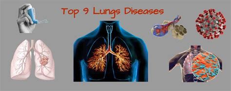 Top 9 Respiratory Disease- Causes, Signs and Symptoms | by Romit ...