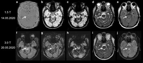 Diagnostic value of different MRI sequences in the detection of ...