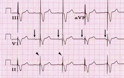 File:ECG pacemaker syndrome.svg - Wikimedia Commons