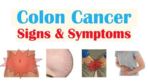 Colon Cancer (CRC) Signs & Symptoms (& Why They Occur) - YouTube