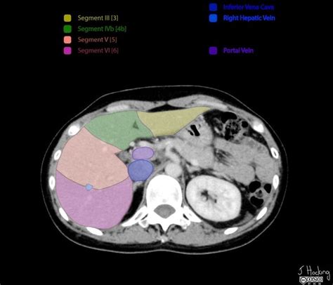 Liver segments: annotated CT | Radiology Case | Radiopaedia.org | Liver anatomy, Radiology ...