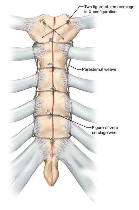 Parasternal wire weave for binding sternum post sternotomy. Copyright ...