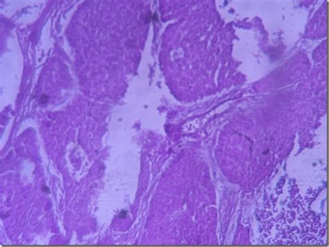 Histology Slides Database: Basal cell carcinoma histopathology