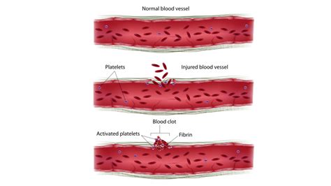 Factor IV (Calcium) Coagulation Blood Test