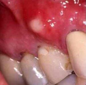 White Spots on Gums, on Baby, Painful Small White Bumps, Patches, Dots above Tooth Treatment