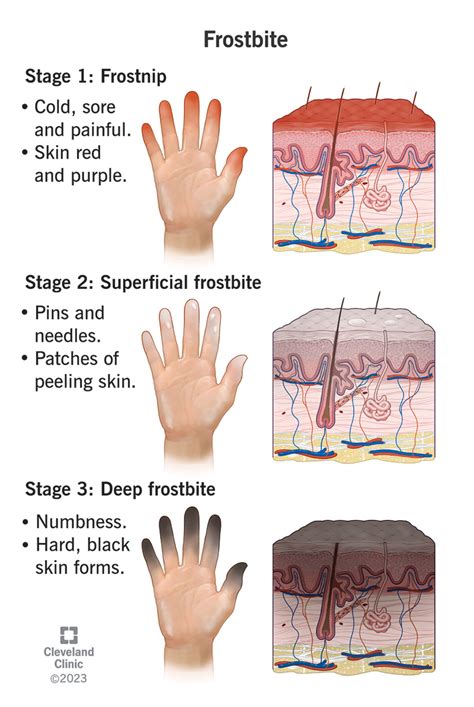 Frostbite: Signs & Symptoms, Stages, Treatment & Prevention