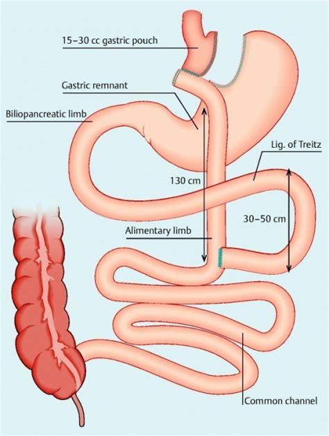 Roux-en-Y gastric bypass configuration. The proximal | Open-i