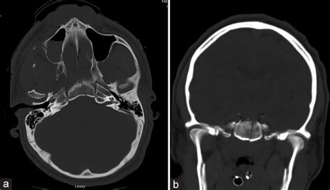 Surgical Neurology International