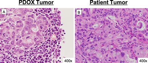 Concordance between patient histology and pancreatic cancer PDOX.... | Download Scientific Diagram