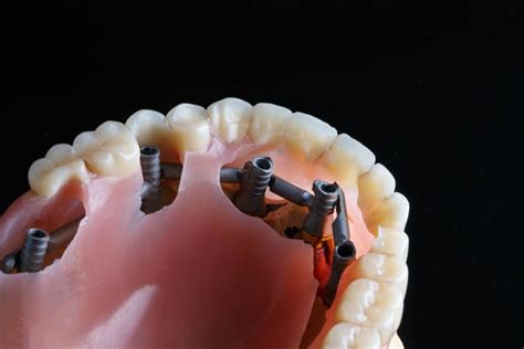 How Long Does the Procedure for Implant Supported Dentures Take? - Brookfield Family Dentistry ...