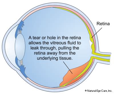 Retinal Detachment | Information, Symptoms & Treatment of Detached Retina