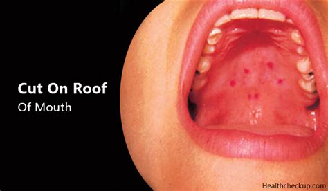 Cut on Roof of Mouth - Causes, Treatment, Prevention by Dr. Himanshi