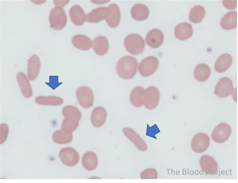 Elliptocytes • The Blood Project