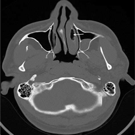 Cureus | Concha Bullosa of the Inferior Turbinate: Report of Two Cases