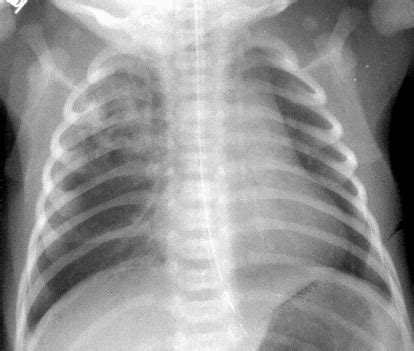 Congenital Pulmonary Airway Malformations (CPAM) – the abnormality ...