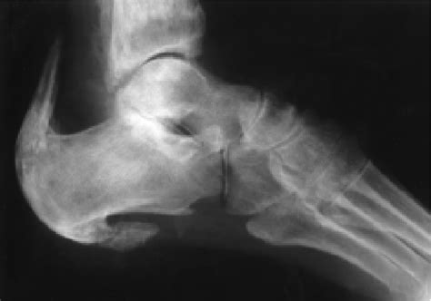 Figure 1 from Massive Calcaneal Enthesopathy in a Non-Healing Leg Ulcer ...