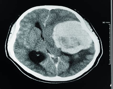 Can a CT Scan Detect a Brain Tumor? » Scary Symptoms