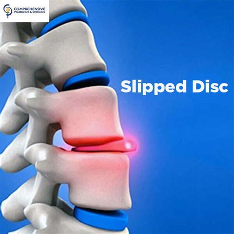 Slipped Disc: Types, Causes, Risk & Symptoms Explained