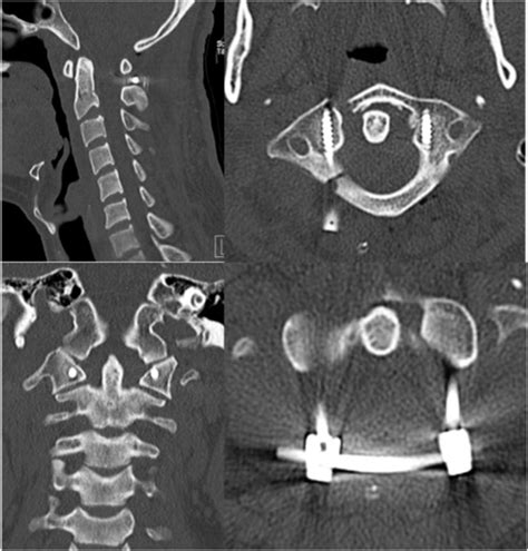 Direct Fixation of C1 Jefferson Fracture Using C1 Lateral Mass Screws: A Case Report ...