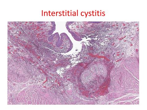 PPT - Interstitial cystitis PowerPoint Presentation, free download - ID ...