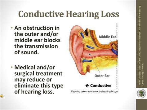 PPT - Understanding Hearing Loss PowerPoint Presentation, free download - ID:4825977