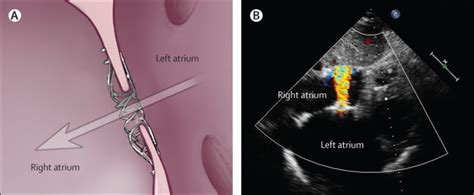 A transcatheter intracardiac shunt device for heart failure with ...