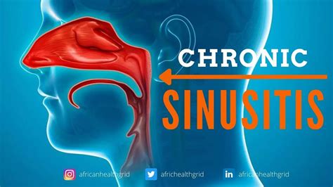 Chronic Sinusitis: What is Chronic Sinusitis? Prevention and Treatment ...