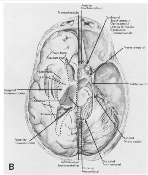 Figure 3 from Microsurgical anatomy of the region of the tentorial incisura. | Semantic Scholar