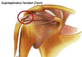 Supraspinatus Tendon Tear