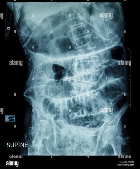 Small bowel obstruction ( film x-ray abdomen ( supine position Stock ...