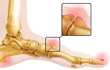 Lump On Top Of Foot: Common Causes & Treatment