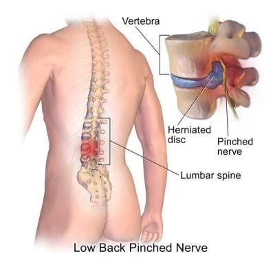 Lower back pain advice - Milton Keynes University Hospital
