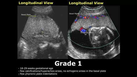 Placental Grading On Ultrasound | Grade 0, 1, 2, 3 Placenta USG - YouTube