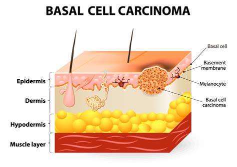 Basal Cell Carcinoma (BCC) - Advanced Skin and Laser Center