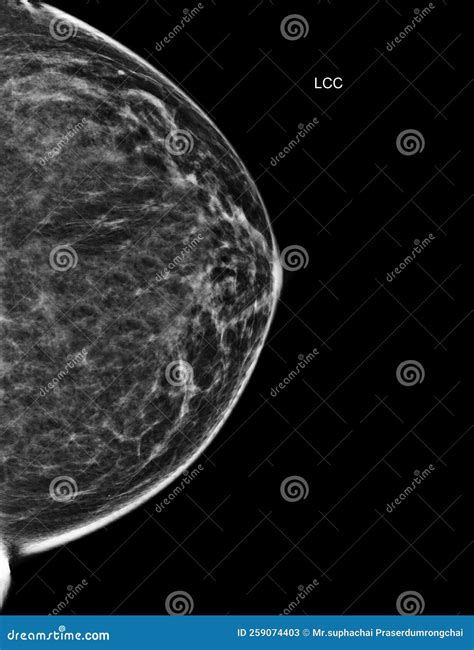 X-ray Digital Mammogram Or Mammography Of Both Side Breast Standard ...