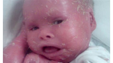 Lamellar Ichthyosis Baby