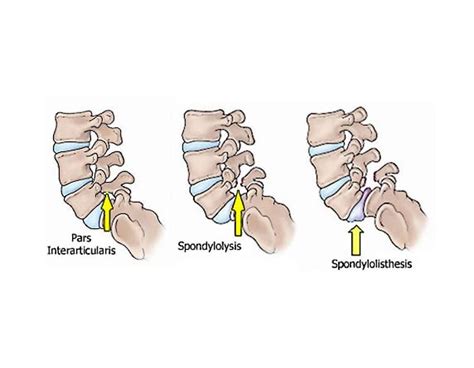 Spondylolisthesis & Spondylolysis Causes And Best Treatment