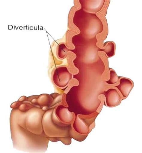 News on how to help diverticulitis yourself very useful advice