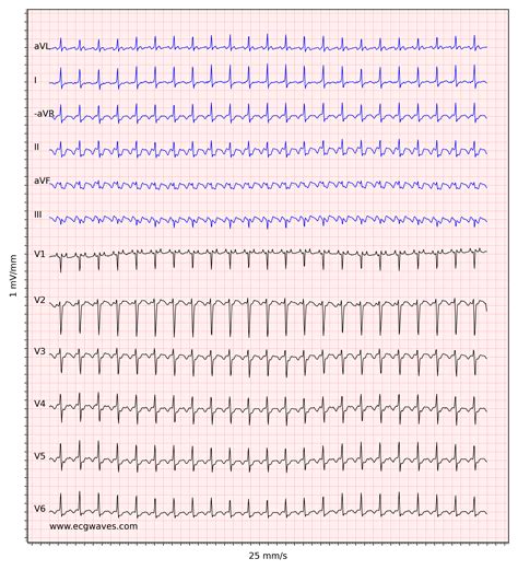 Atrial flutter: classification, causes, ECG diagnosis & management – ECG & ECHO