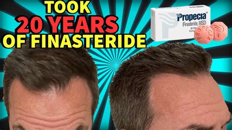 HE TOOK FINASTERIDE FOR 20 YEARS AND THIS IS WHAT HAPPENED. - YouTube